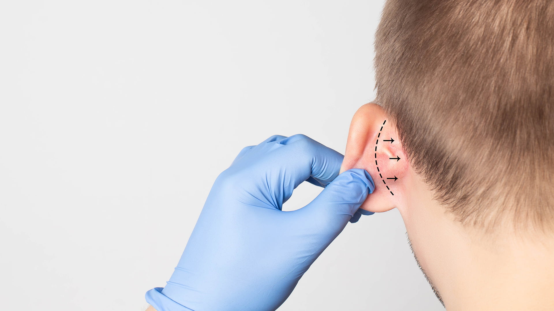 korekcija ušnih školjki