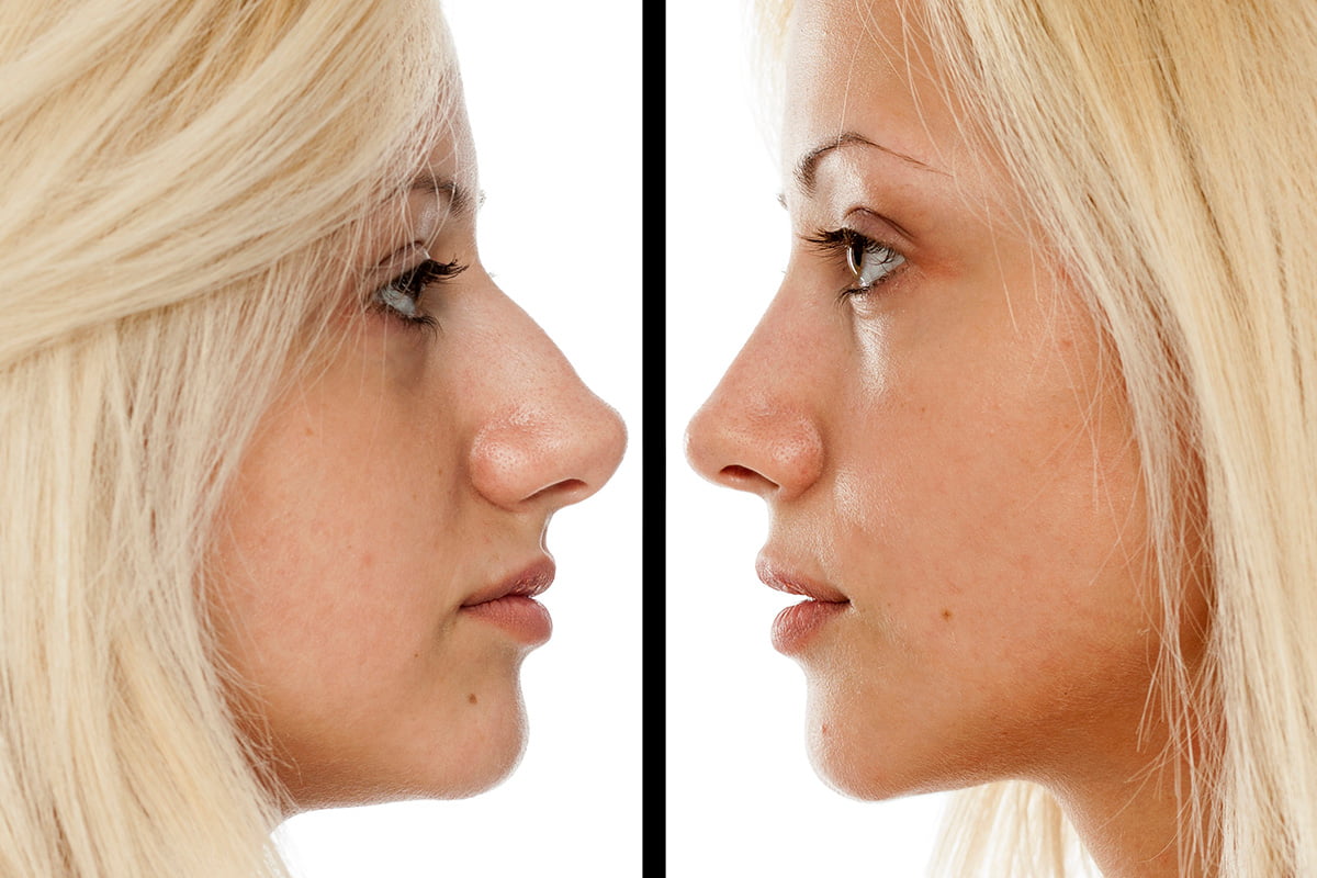 Operacija nosa Andrea Pavlov