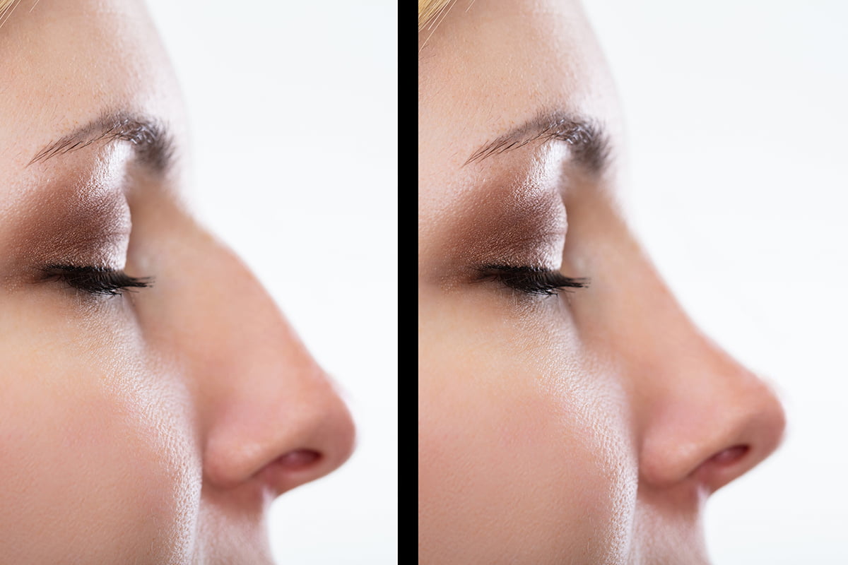 Operacija nosa Madlena Kisic