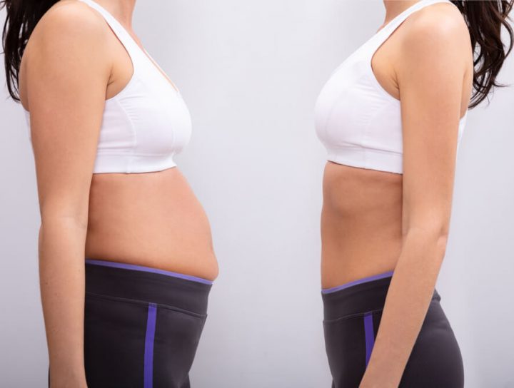 abdominoplastika zatezanje stomaka Eterna Centar 1