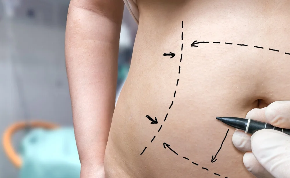abdominoplastika zatezanje stomaka Eterna Centar 3