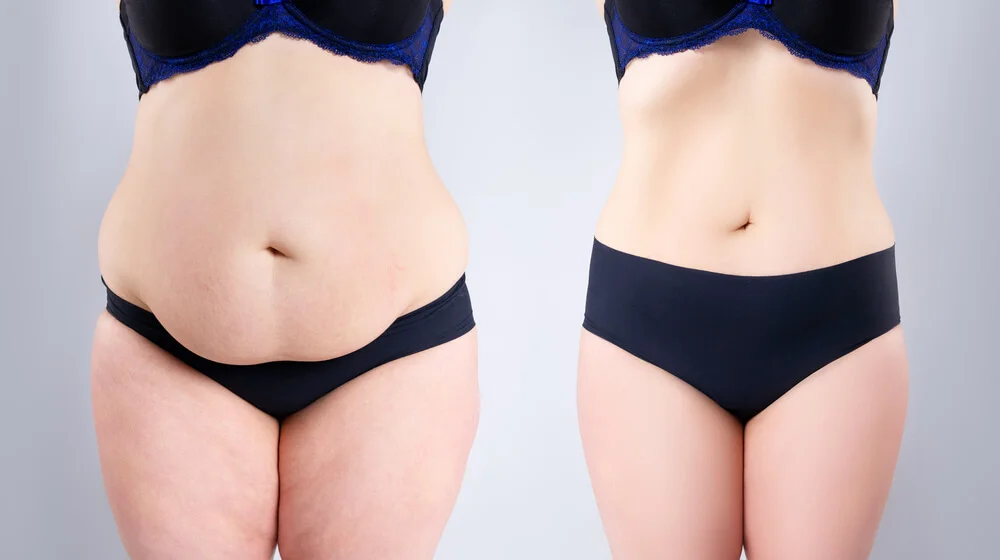 abdominoplastika zatezanje stomaka Eterna Centar 4