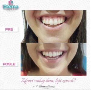Gummy smile, eterna korekcija botoksom
