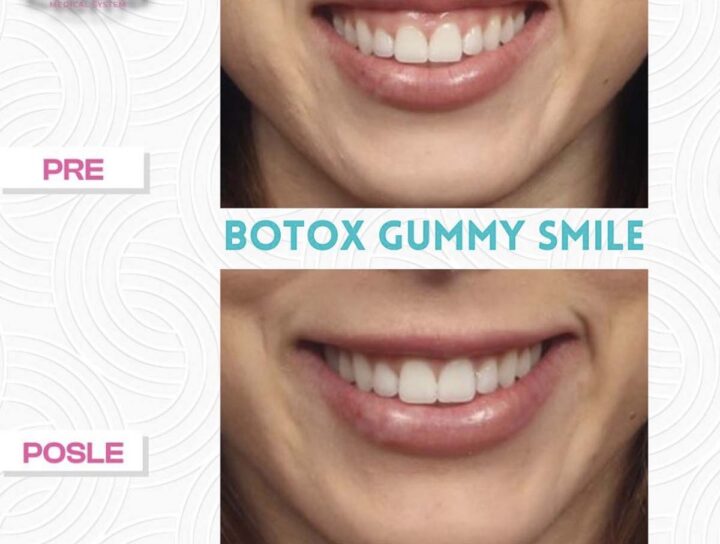 Gummy smile, korekcija botulin toksinom