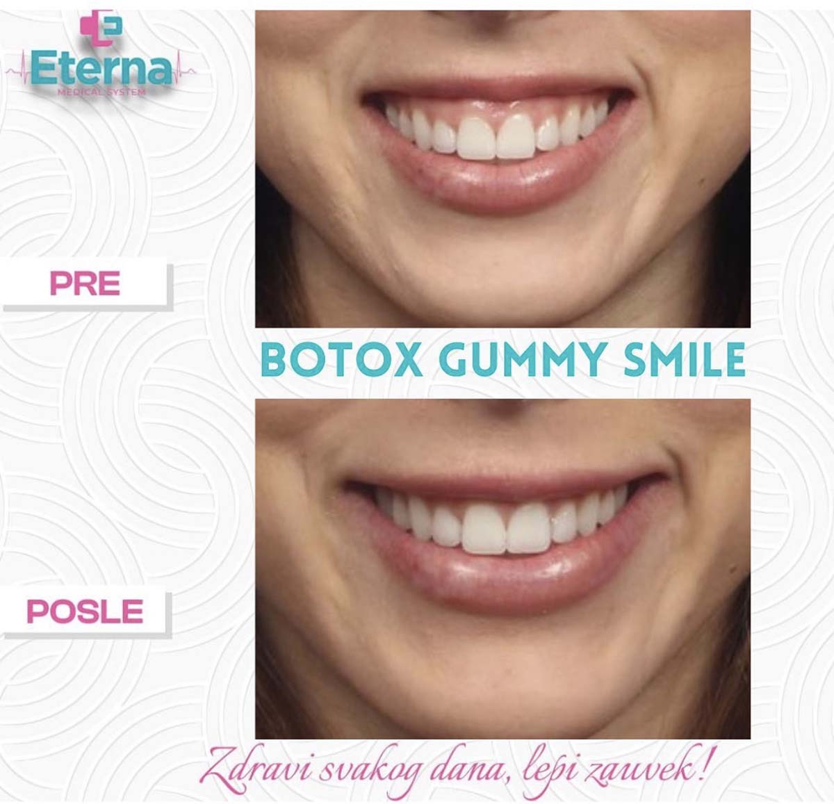 Gummy smile, korekcija botulin toksinom