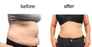 Liposukcija stomaka