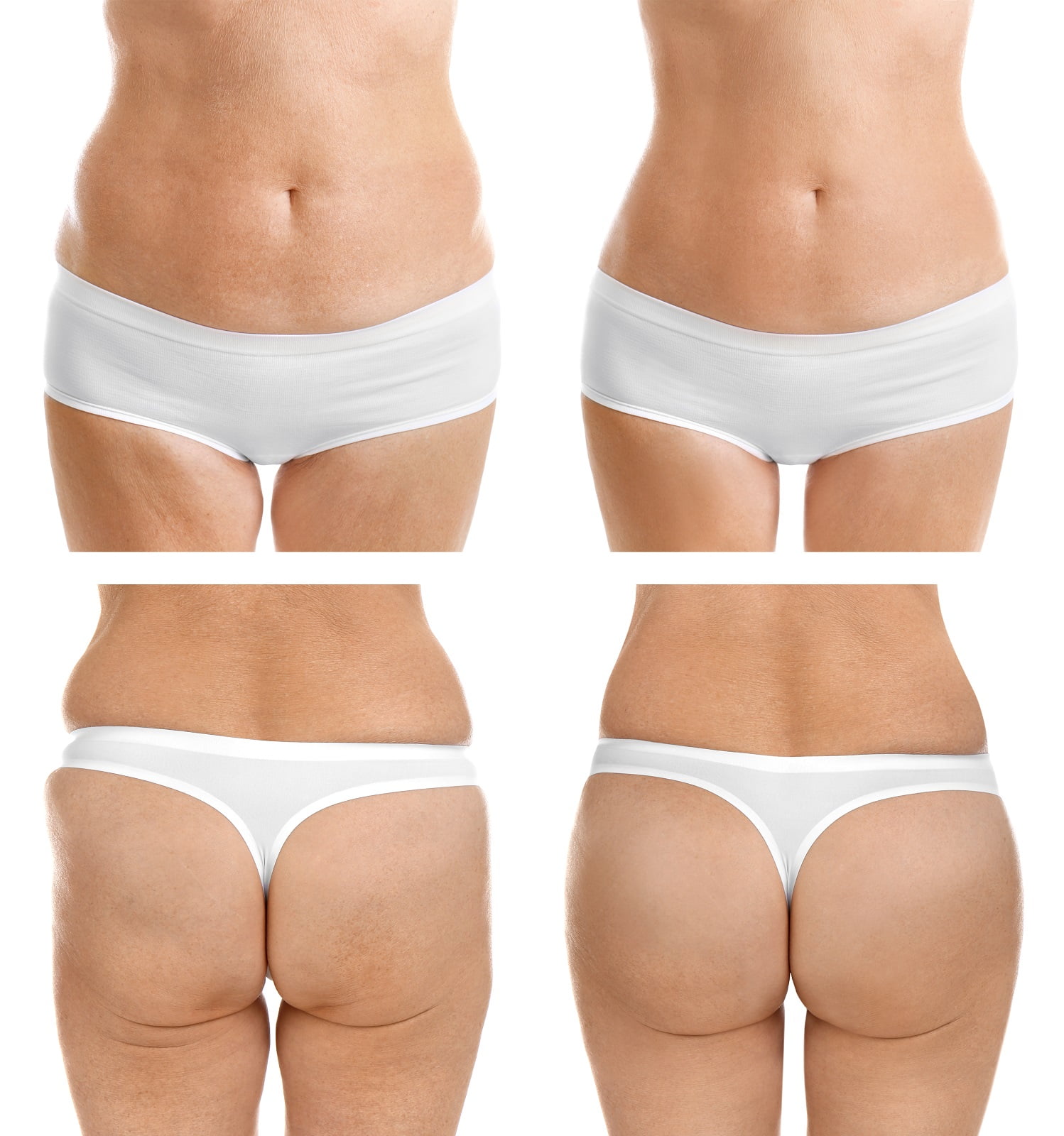 Liposukcija stomaka
