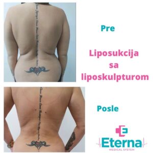 liposukcija