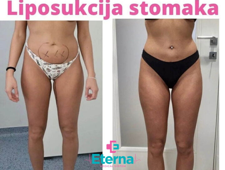 metoda liposukcije stomaka
