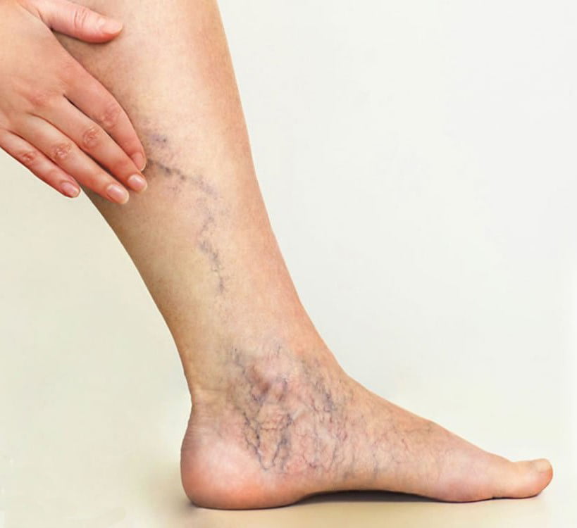 Uzrok proširenih vena