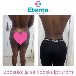 Liposukcija i liposkulptura