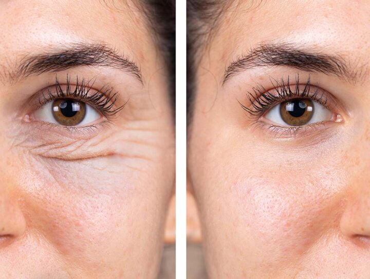 Blefaroplastika, uklanjanje podočnjaka