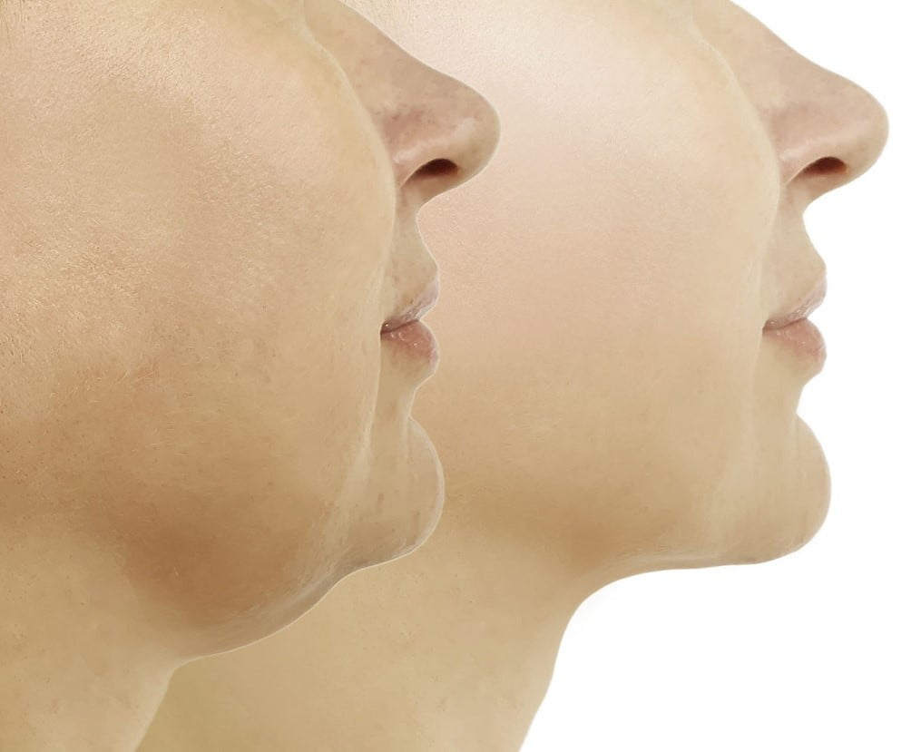 Podbradak, zatezanje vrata