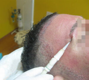 transplantacija obrva