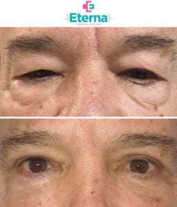 Blefaroplastika, opercija kapaka