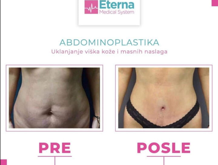 zatezanje stomaka