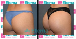 Eterna podizanje guzice