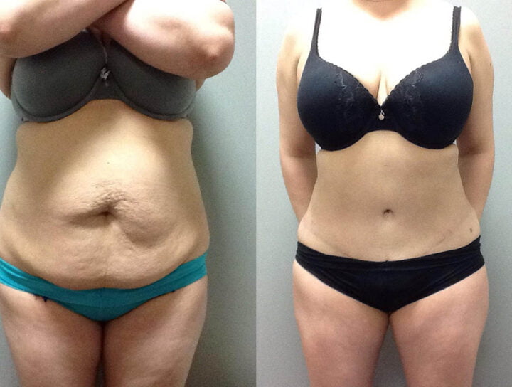 Abdominoplastika