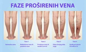 Faze proširenih vena na nogama
