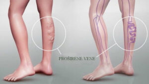 Proširene vene na nogama